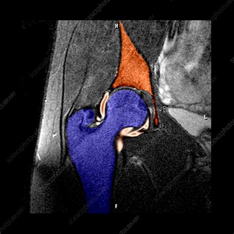 Hip Labral Tear Stock Image C003 4621 Science Photo Library