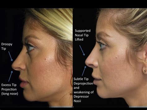A Comprehensive Guide To Natural Rhinoplasty Beverly Hills
