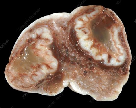 Human Ovary With Corpus Luteum Stock Image C Science Photo Library