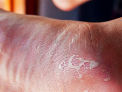 Acral Peeling Skin Syndrome Signs Causes Treatment More