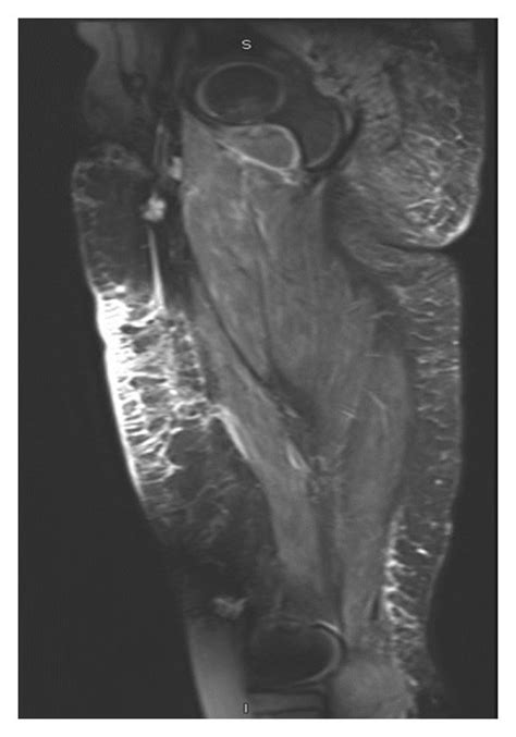 Mri Imaging Of Thigh Sagittal Fat Suppressed T2 Weighted Images