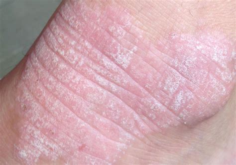 Corner radius for the lm rail. Dermatitis herpetiformis: Causes, treatment, and pictures