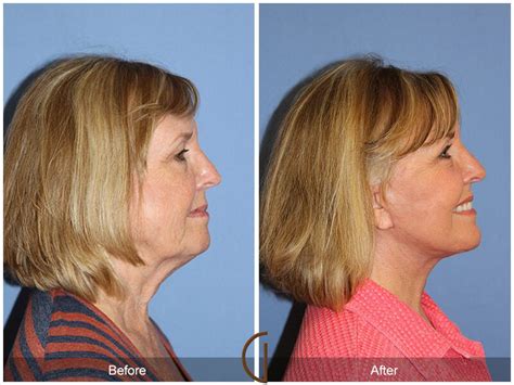Neck Lift Before And After Photos Patient 38 Dr Kevin Sadati