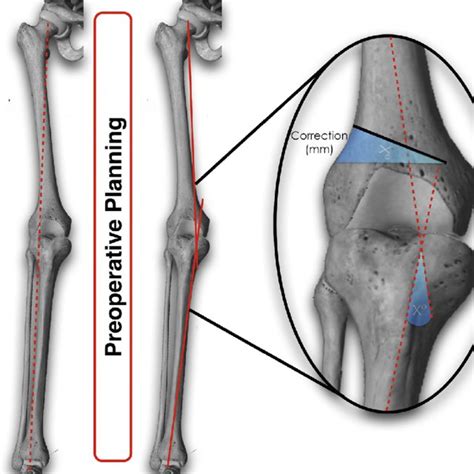 Expansion Of The Distal Femoral Cortical Defect In A Right Femur With A