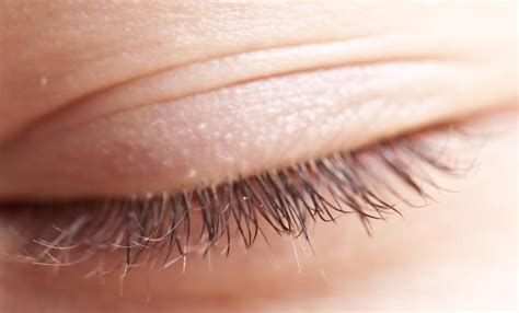 How Do I Treat An Ingrown Eyelash With Pictures