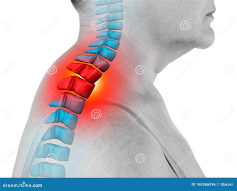 Neck Pain Sciatica And Scoliosis In The Cervical Spine Isolated On