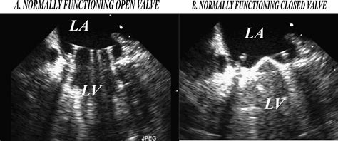 Acute Occlusion Of A Bileaflet Mechanical Mitral Valve Prosthesis