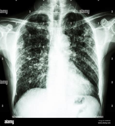 Tipos De Infiltrados Pulmonares