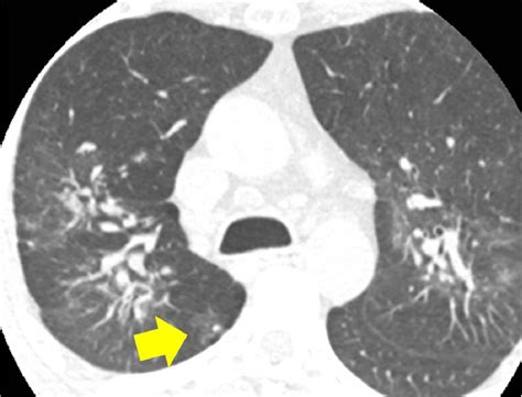Figure 27 From Typical And Atypical Manifestations Of Chronic Pulmonary