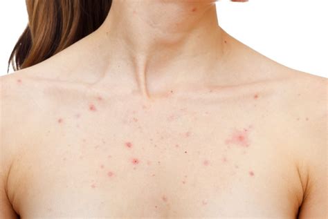 Best Treatments For Chest Acne Affordable And Efficient Mdacne