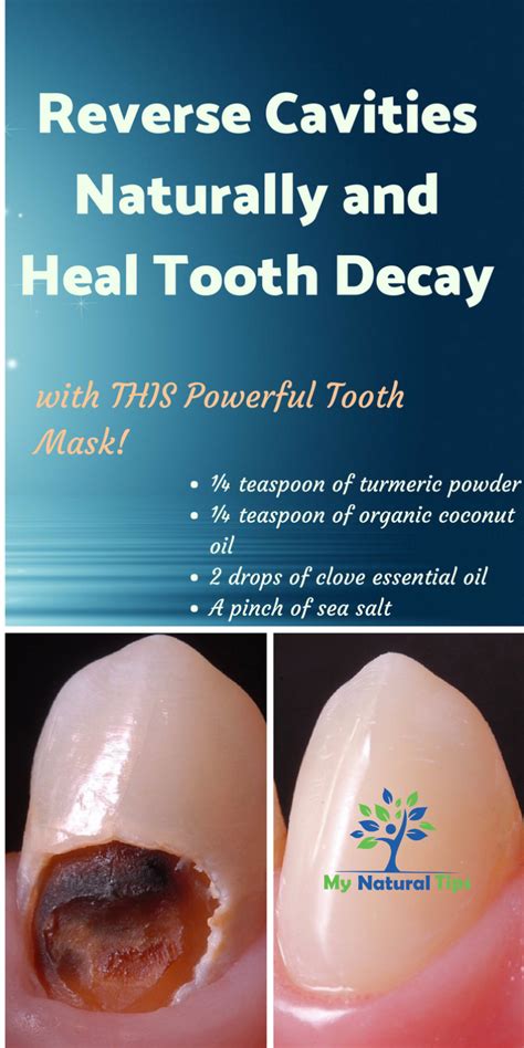How To Heal Tooth Decay And Reverse Cavities Naturally Tooth Decay