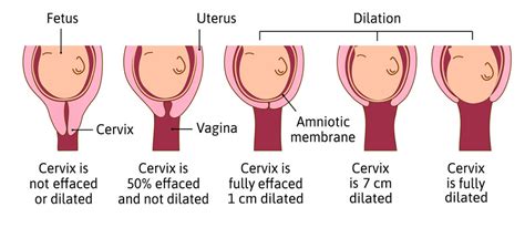 Es una manifestación asociada al inicio de la dilatación del cuello cervical , es decir el comienzo del trabajo de parto; Tapon mucoso ¿Cómo es y cuándo se expulsa? » Nadie como mamá