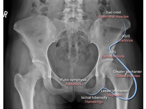 Anterior Inferior Iliac Spine Avulsion AIIS Knee Sports Orthobullets