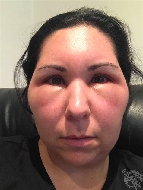 Woman S Face Balloons After Severe Allergic Reaction To Hair Dye