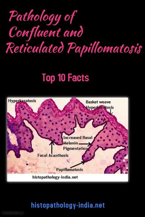 Pathology Of Confluent And Reticulated Papillomatosis Top 10 Facts