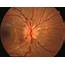 Optic Neuritis – Sequential To Other Causes PEDGAZ
