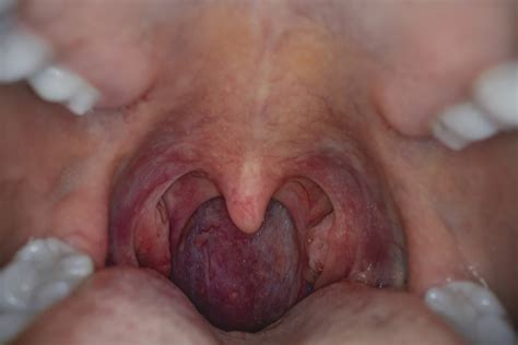 What Does Cancer In Throat Look Like Oral Cancer Screening Brook