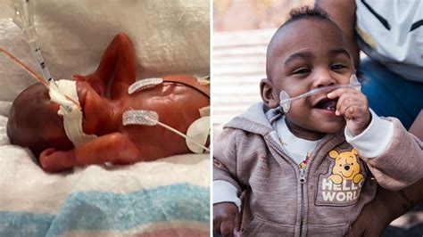 Worlds Most Premature Baby Defies Less Than 1 Survival Odds To Make