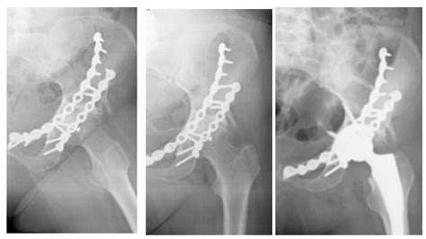 WHICH PROBLEMATICS IN THA AFTER ACETABULAR FRACTURES EXPERIENCE OF 38