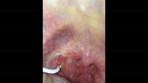 Still Getting Tonsil Stones After Tonsillectomy Youtube