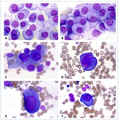 Images From The Haematologica Atlas Of Hematologic Cytology Plasma Cell Myeloma Haematologica