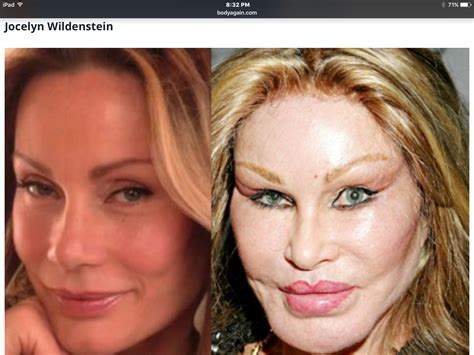 Pin By Happygal831 On BEFORE AFTER Bad Celebrity Plastic Surgery