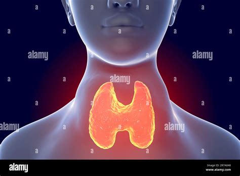 Toxic Diffuse Goiter Flajani Basedow Graves Disease 3d Illustration