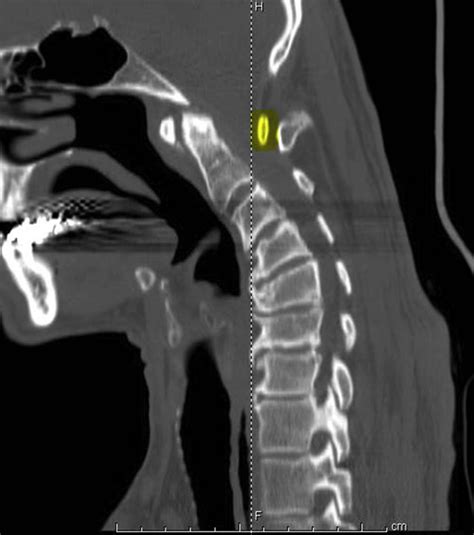 Severe C1c2 Atlantoaxial Subluxation With Laminar Overlap The Spine