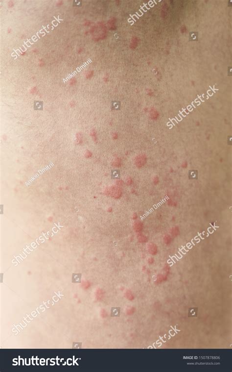 Skin Imperfection Skin Allergy Urticaria Disease Stock Photo 1507878806