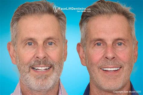 For advice on pursuing jaw surgery to fix an extreme overbite scroll down. Overbite Correction Explained | Adult Options and Treatment