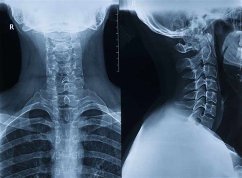 Cervical Rib Anatomy Associated Conditions Treatment