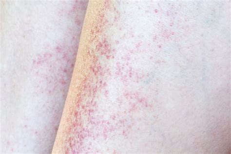 Pinprick Red Dots On Skin But Not Itchy Causes Pictures