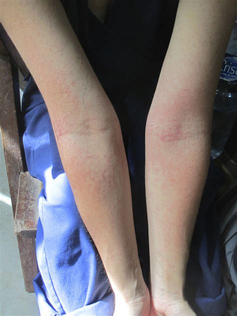 The rash is the appearance of red colored areas on the skin. Idiots Abroad