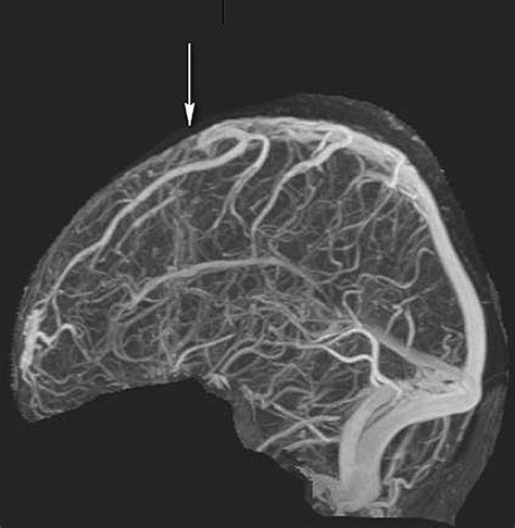 Dural Sinus Thrombosis A Not So Unusual Clinical Presentation