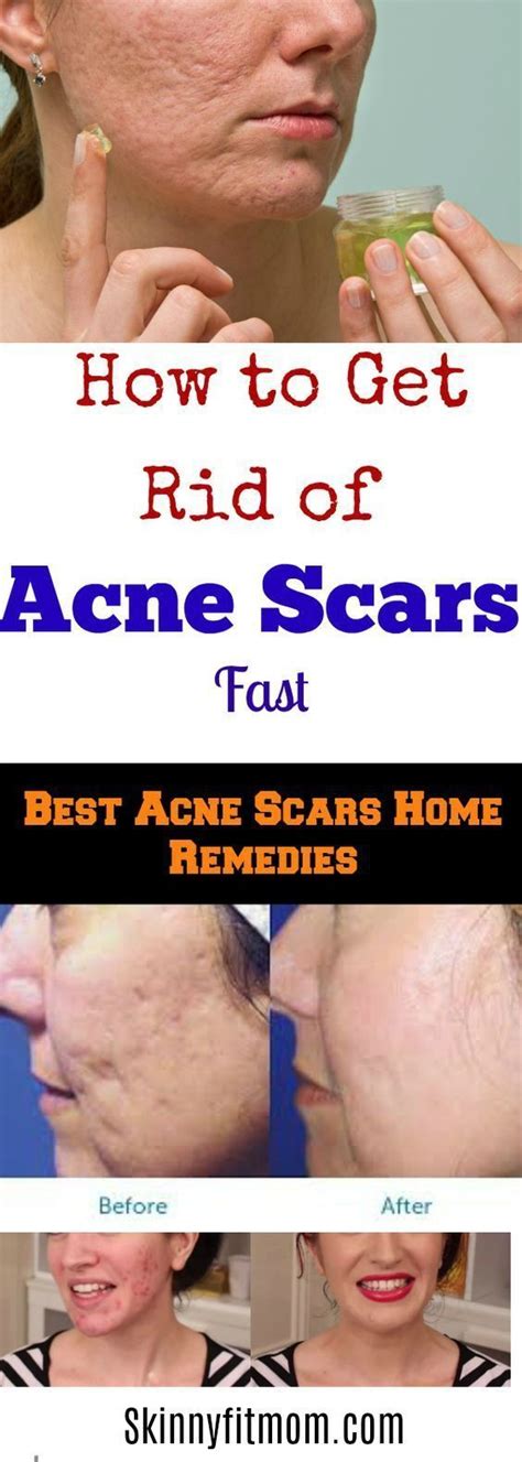 Pin On Acne Scars Treatment