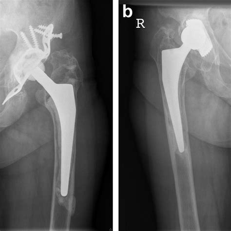 Revision Of The Left Total Hip Arthroplasty Using A Transfemoral