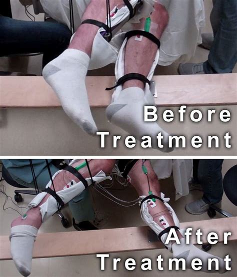 Paralyzed Men Move Legs With New Non Invasive Spinal Cord Stimulation