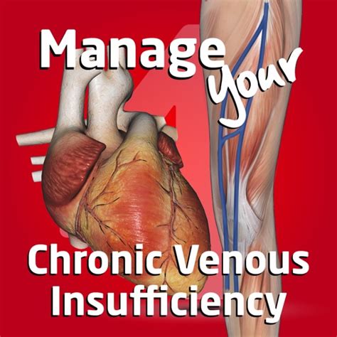 Manage Your Chronic Venous Insufficiency 4 By Epat