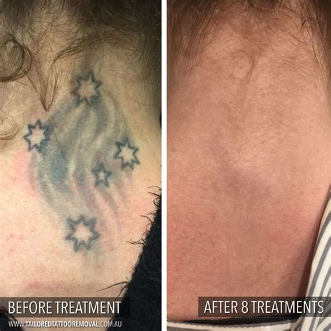 Laser Tattoo Removal Results After First Treatment Best Tattoo Ideas