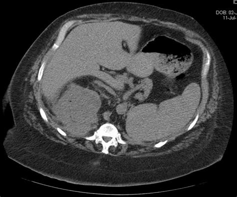 Axial Ct Demonstrating A Large Right Sided Perinephric Abscess