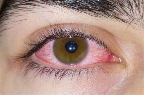 Pink Eye Treatment Ujivan Helth