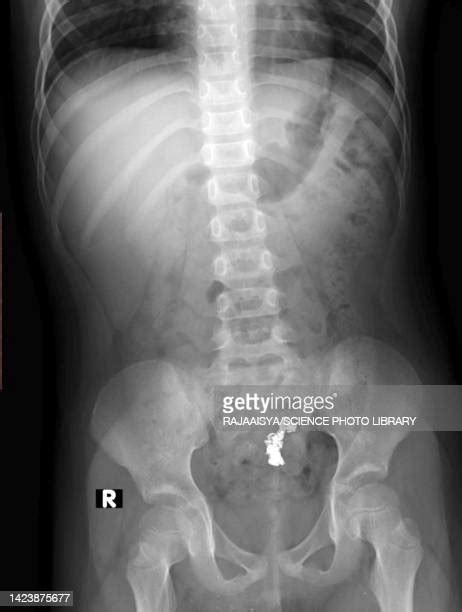 X Ray Swallowed Photos And Premium High Res Pictures Getty Images