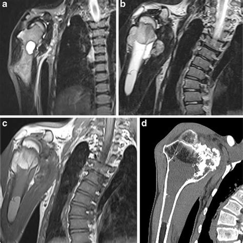 Multiple Long Bone Cysts Revealed By Mri In Trichorhinophalangeal