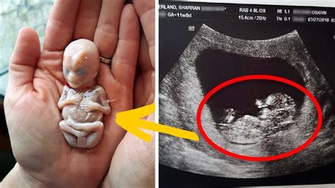 Weeks After This Mother Gave Birth Doctors Found A Deadly Unborn Baby Growing Inside Her