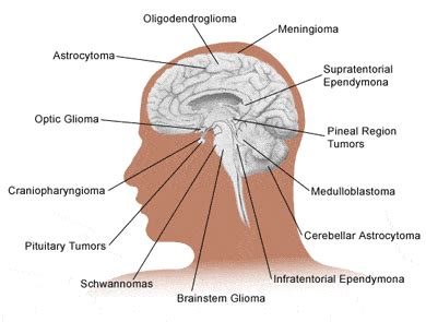 Brain Tumors Nashville Neurosurgery Associates