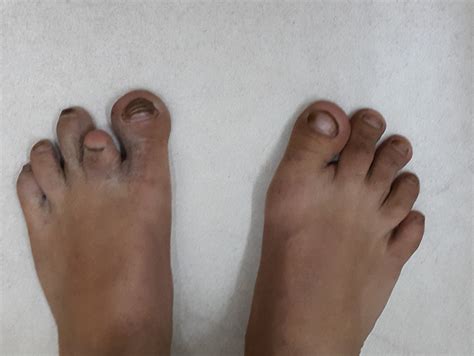 Feet Showing Discoloured Toes Short Left 2 Nd Toe And The Dysplastic Nails
