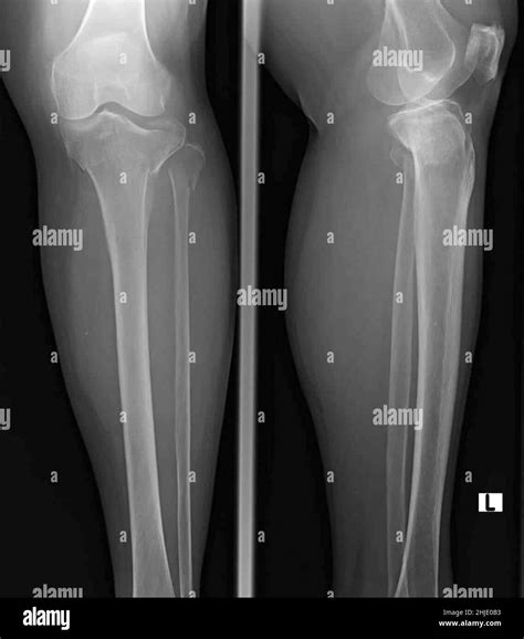 Proximal Tibia Anatomy