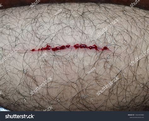 Bloody Wound On Mans Calf Leg Stock Photo 1282403980 Shutterstock
