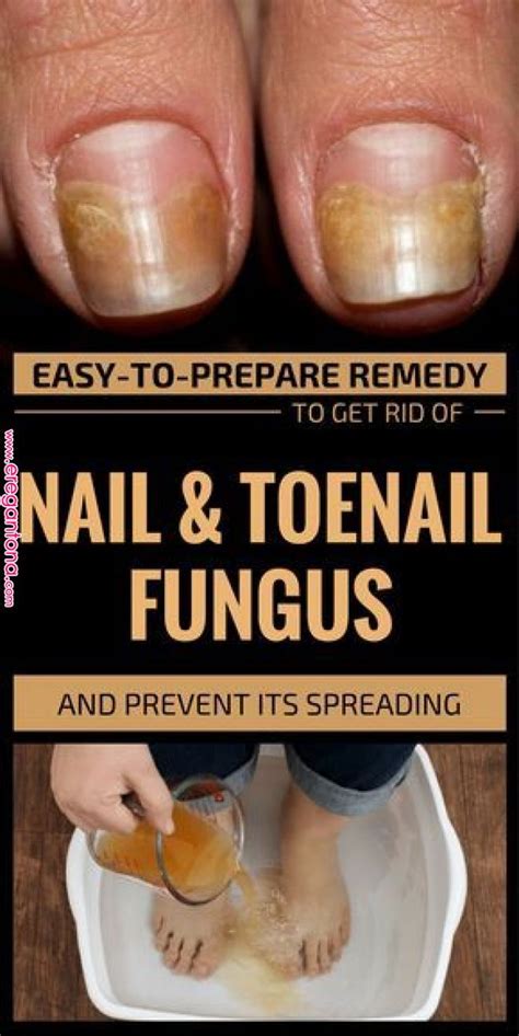 Easy To Prepare Remedy To Get Rid Of Nail And Toenail Fungus And