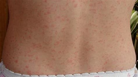 What Causes Little Red Dot On The Skin New Health Advisor